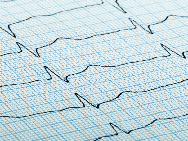 How Tachycardia Affects Healthy People with Anxiety